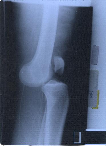 اصابات مفصل الركبه ....وعلاجها KneeBefore.jpg